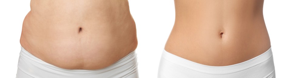 Image of Woman showing her belly with excess fat on one side and slim on other, closeup. Collage with photos before and after weight loss on white background