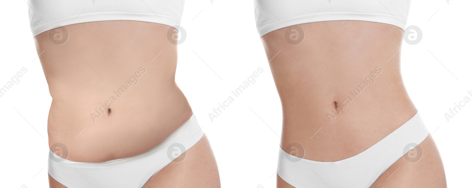 Image of Woman showing her belly with excess fat on one side and slim on other, closeup. Collage with photos before and after weight loss on white background