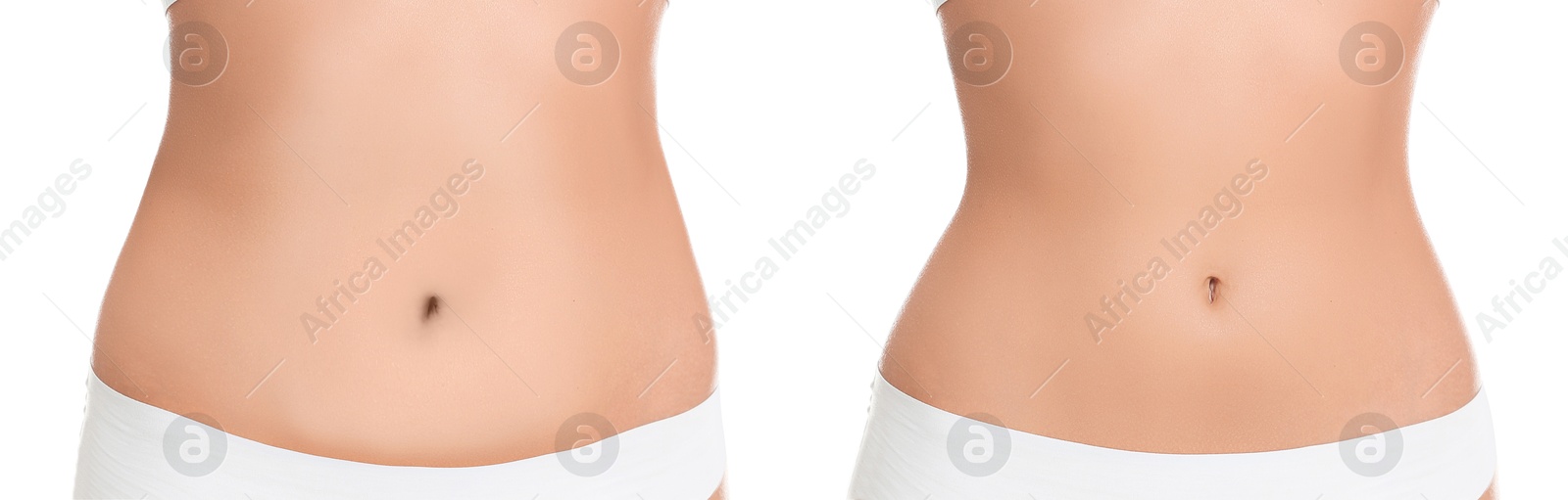 Image of Woman showing her belly with excess fat on one side and slim on other, closeup. Collage with photos before and after weight loss on white background