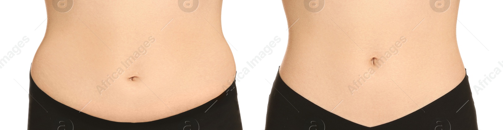 Image of Woman showing her belly with excess fat on one side and slim on other, closeup. Collage with photos before and after weight loss on white background