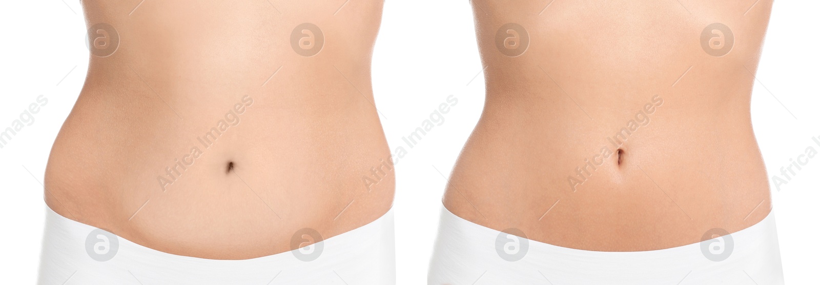 Image of Woman showing her belly with excess fat on one side and slim on other, closeup. Collage with photos before and after weight loss on white background