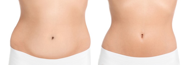 Image of Woman showing her belly with excess fat on one side and slim on other, closeup. Collage with photos before and after weight loss on white background