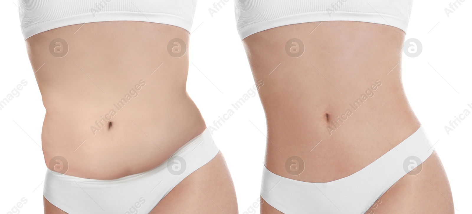 Image of Woman showing her belly with excess fat on one side and slim on other, closeup. Collage with photos before and after weight loss on white background