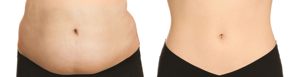 Image of Woman showing her belly with excess fat on one side and slim on other, closeup. Collage with photos before and after weight loss on white background