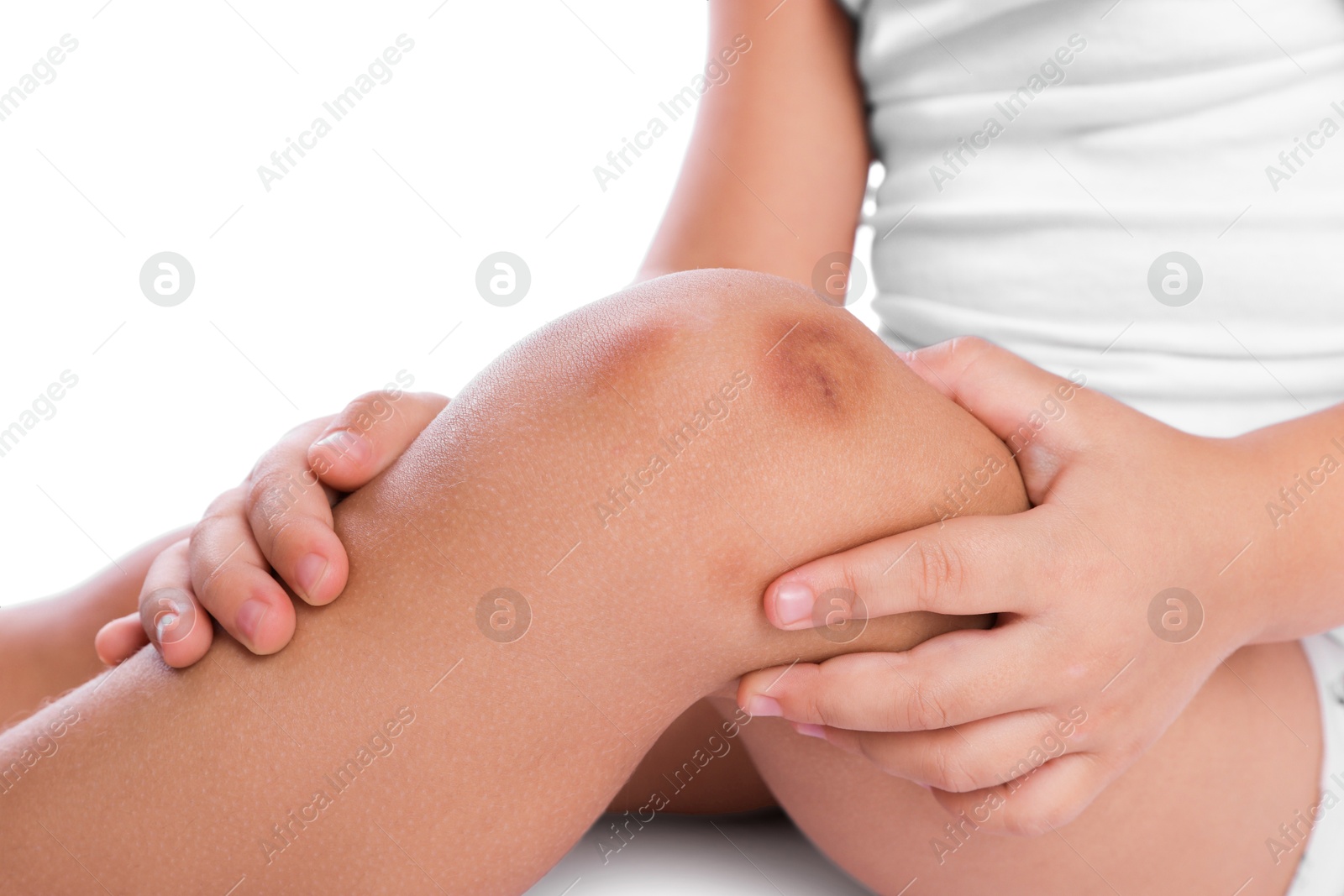 Photo of Child with bruise on leg against white background, closeup