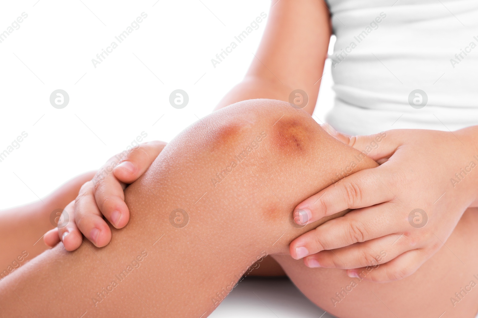 Photo of Child with bruise on leg against white background, closeup