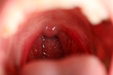 Photo of Closeup view of woman's oral cavity. Sore throat