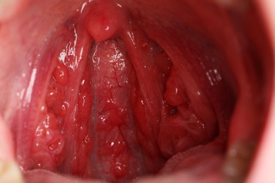 Photo of Closeup view of woman's oral cavity. Sore throat