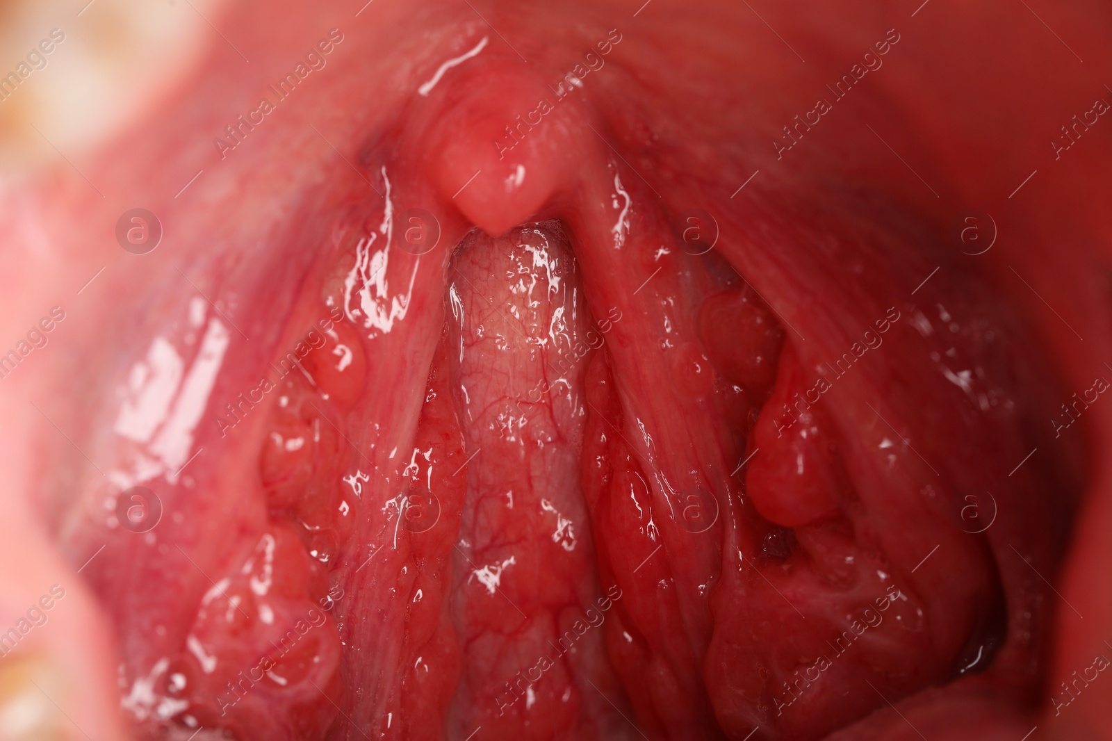 Photo of Closeup view of woman's oral cavity. Sore throat