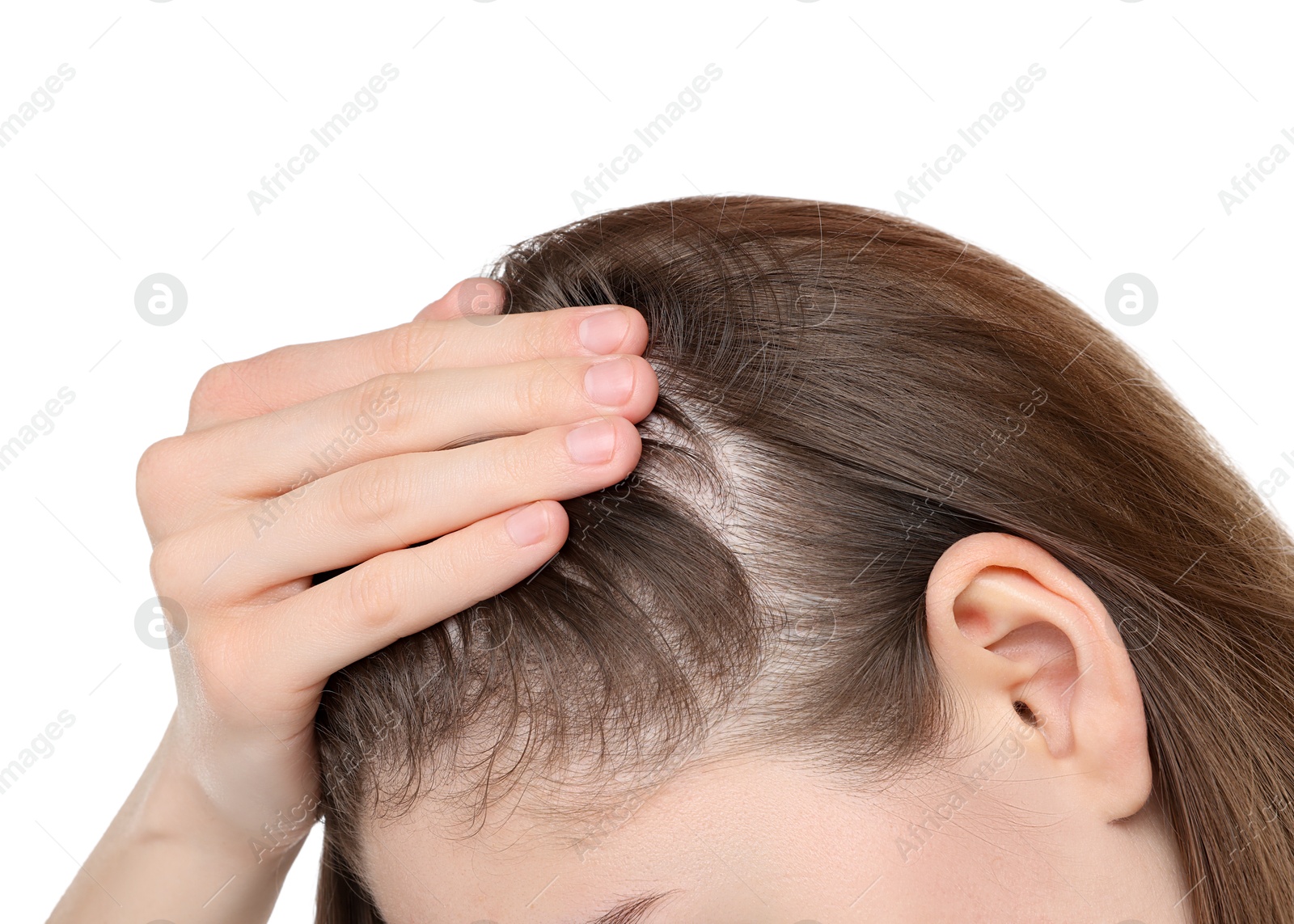 Photo of Girl with hair loss problem on white background, closeup