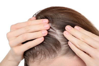 Photo of Girl with hair loss problem on white background, closeup