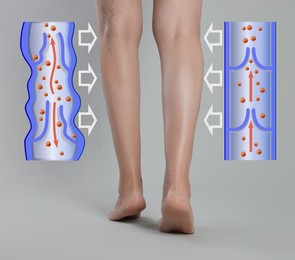 Image of Varicose veins. Woman showing legs on grey background, closeup. Illustrations of damaged and healthy vein, longitudinal section