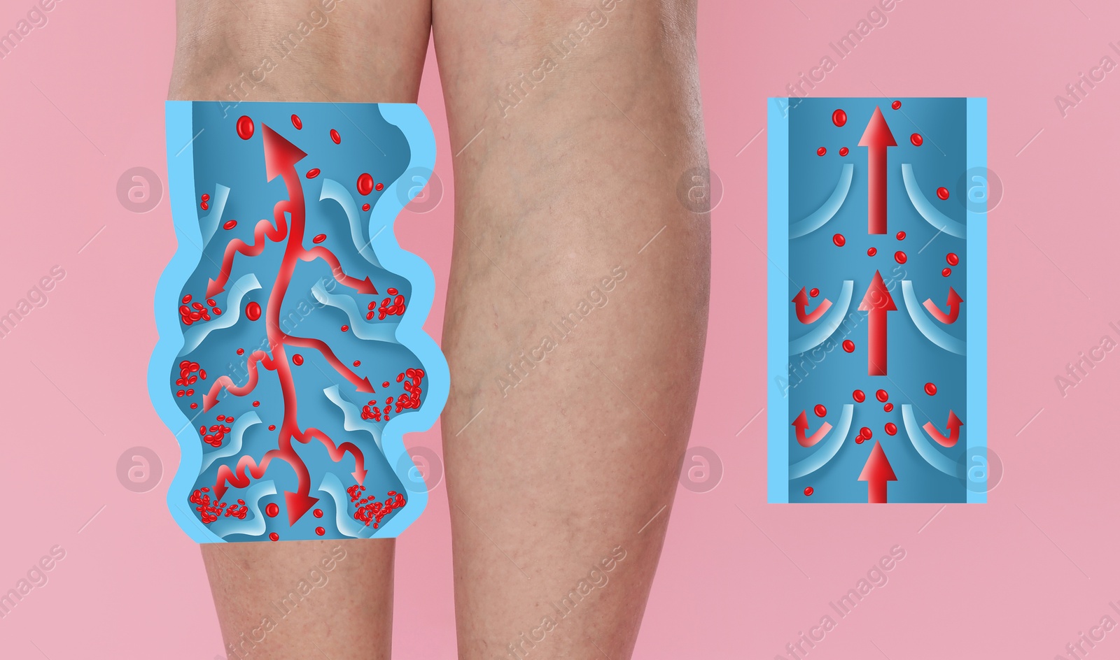 Image of Varicose veins. Woman showing legs on pink background, closeup. Illustrations of damaged and healthy vein, longitudinal section