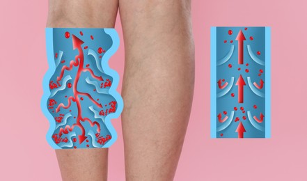 Image of Varicose veins. Woman showing legs on pink background, closeup. Illustrations of damaged and healthy vein, longitudinal section