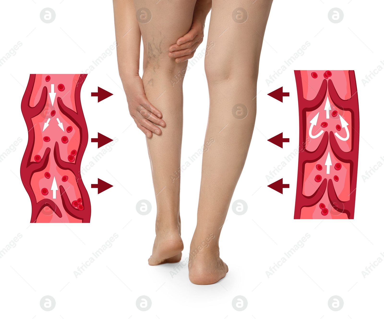 Image of Varicose veins. Woman showing legs on white background, closeup. Illustrations of damaged and healthy vein, longitudinal section