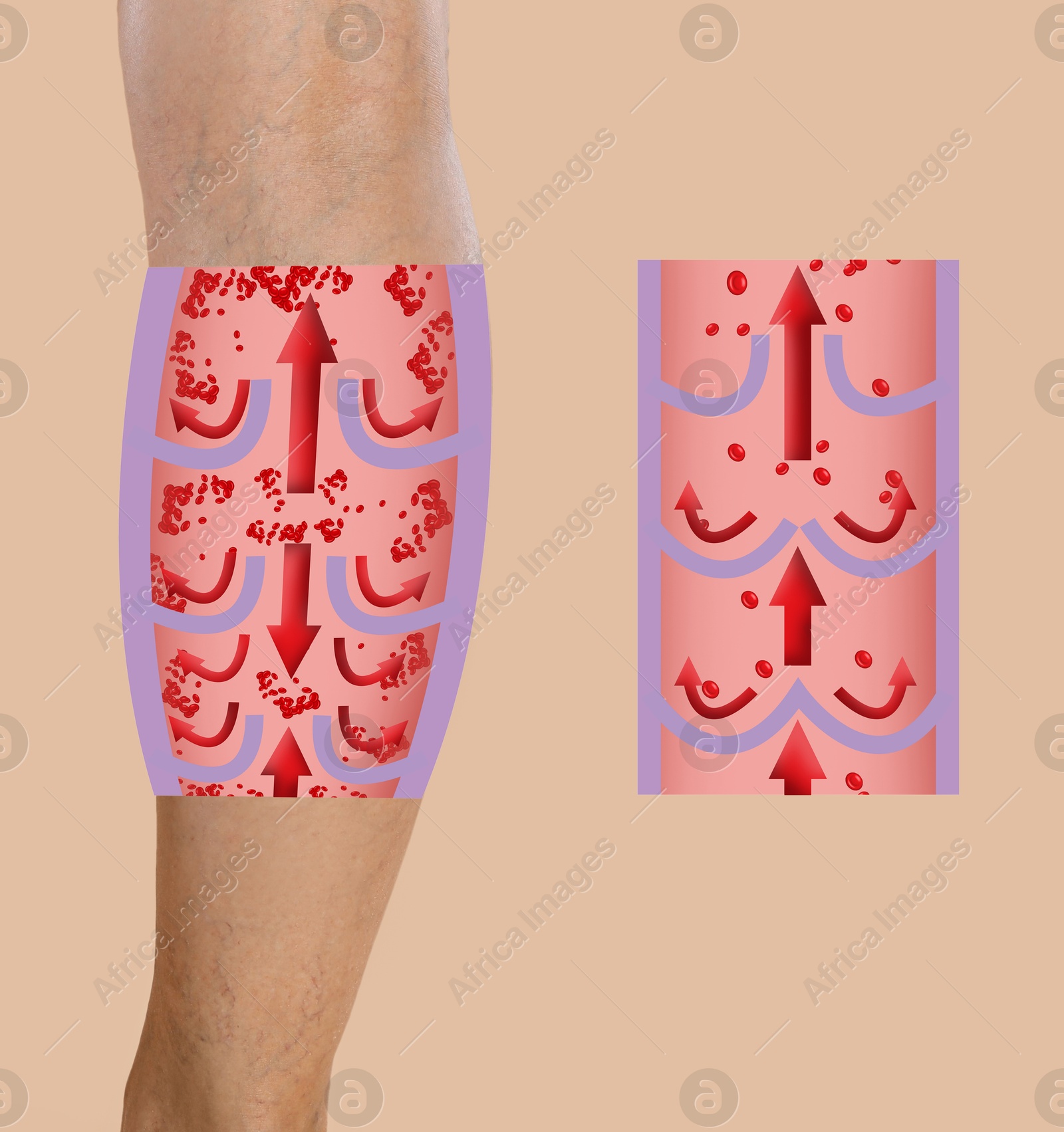 Image of Varicose veins. Woman showing leg on beige background, closeup. Illustrations of damaged and healthy vein, longitudinal section