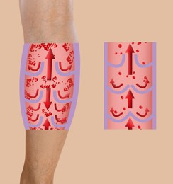 Image of Varicose veins. Woman showing leg on beige background, closeup. Illustrations of damaged and healthy vein, longitudinal section