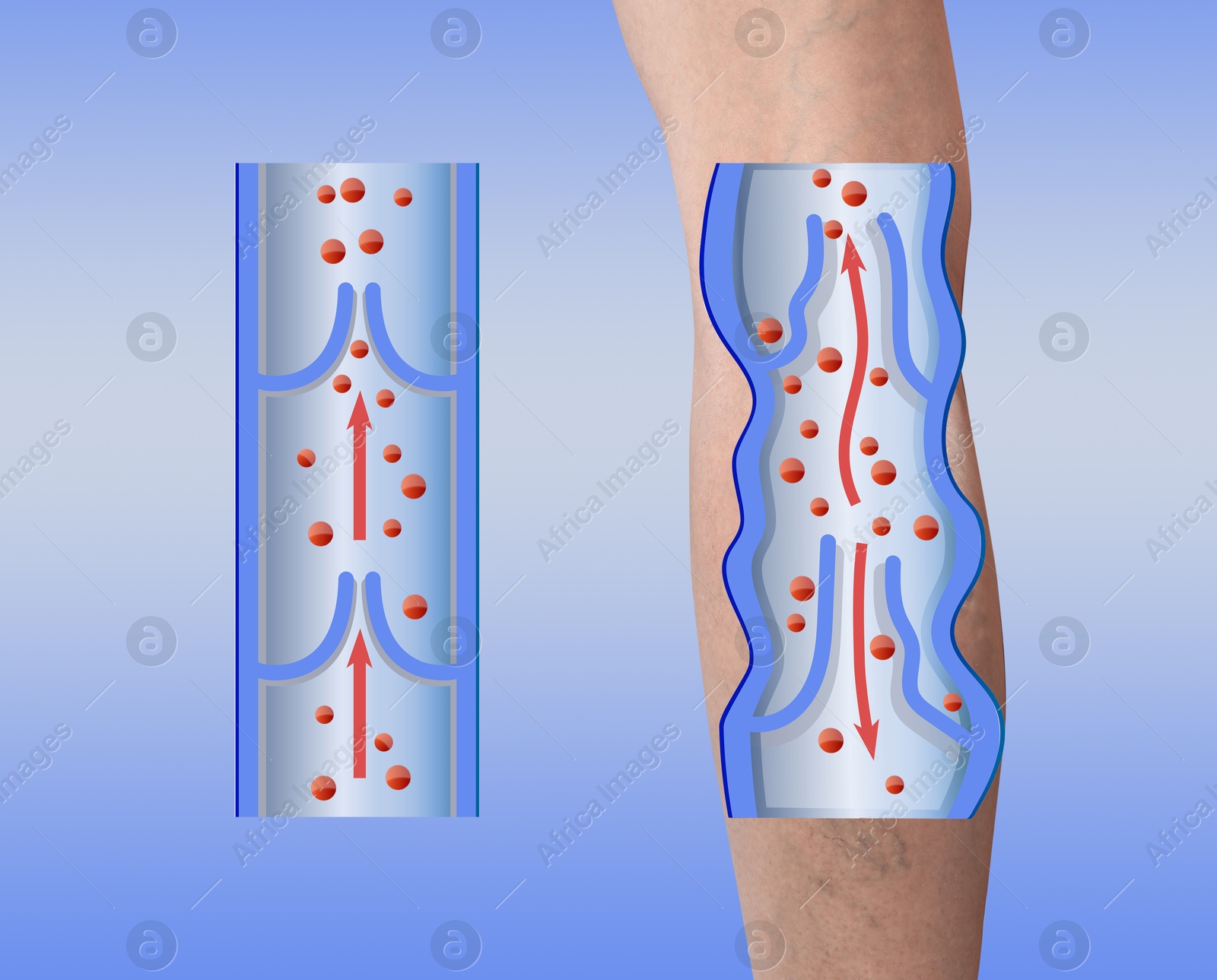 Image of Varicose veins. Woman showing leg on light blue background, closeup. Illustrations of damaged and healthy vein, longitudinal section