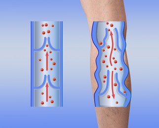 Image of Varicose veins. Woman showing leg on light blue background, closeup. Illustrations of damaged and healthy vein, longitudinal section