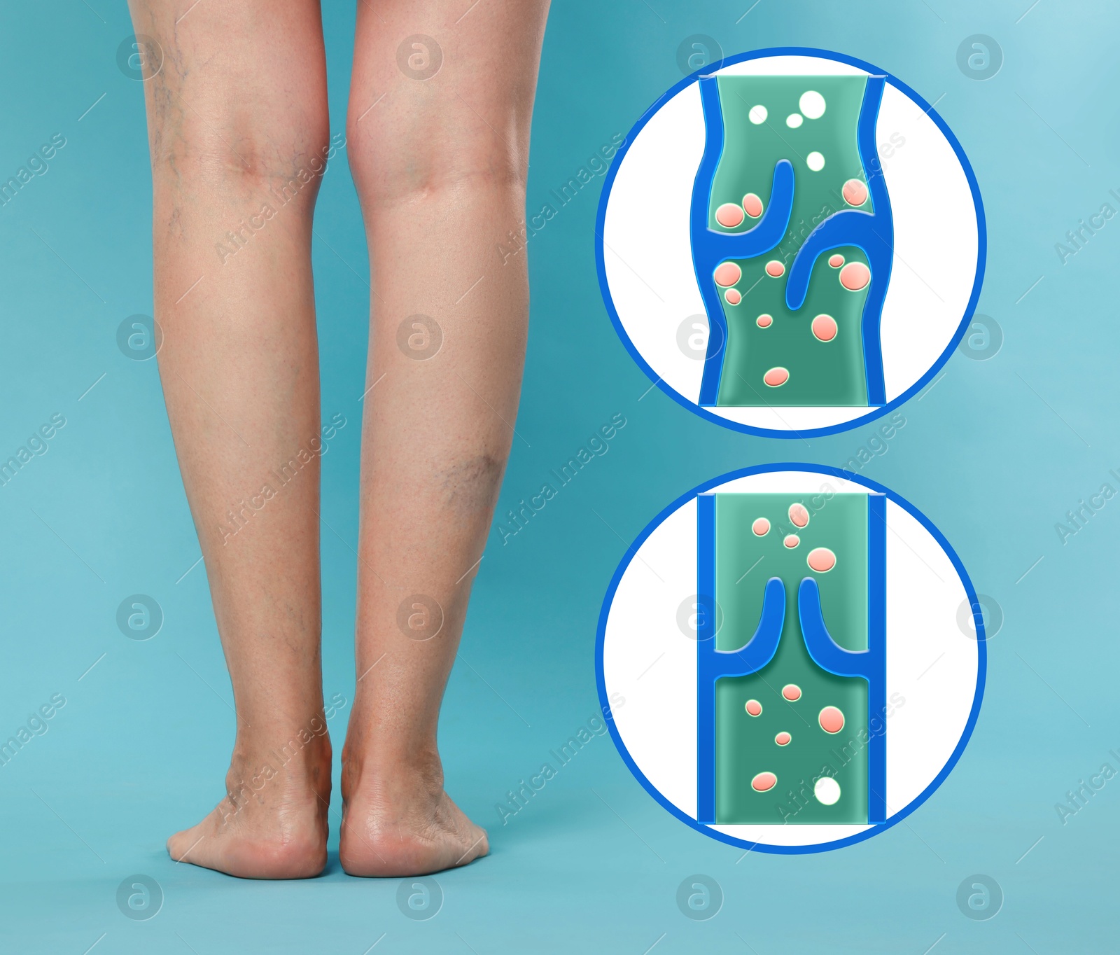 Image of Varicose veins. Woman showing legs on light blue background, closeup. Illustrations of damaged and healthy vein, longitudinal section