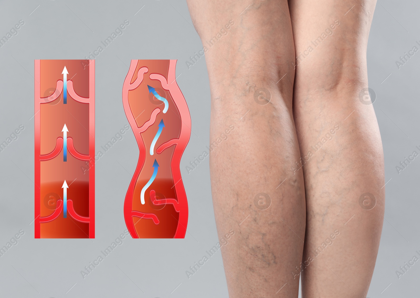 Image of Varicose veins. Woman showing legs on grey background, closeup. Illustrations of damaged and healthy vein, longitudinal section