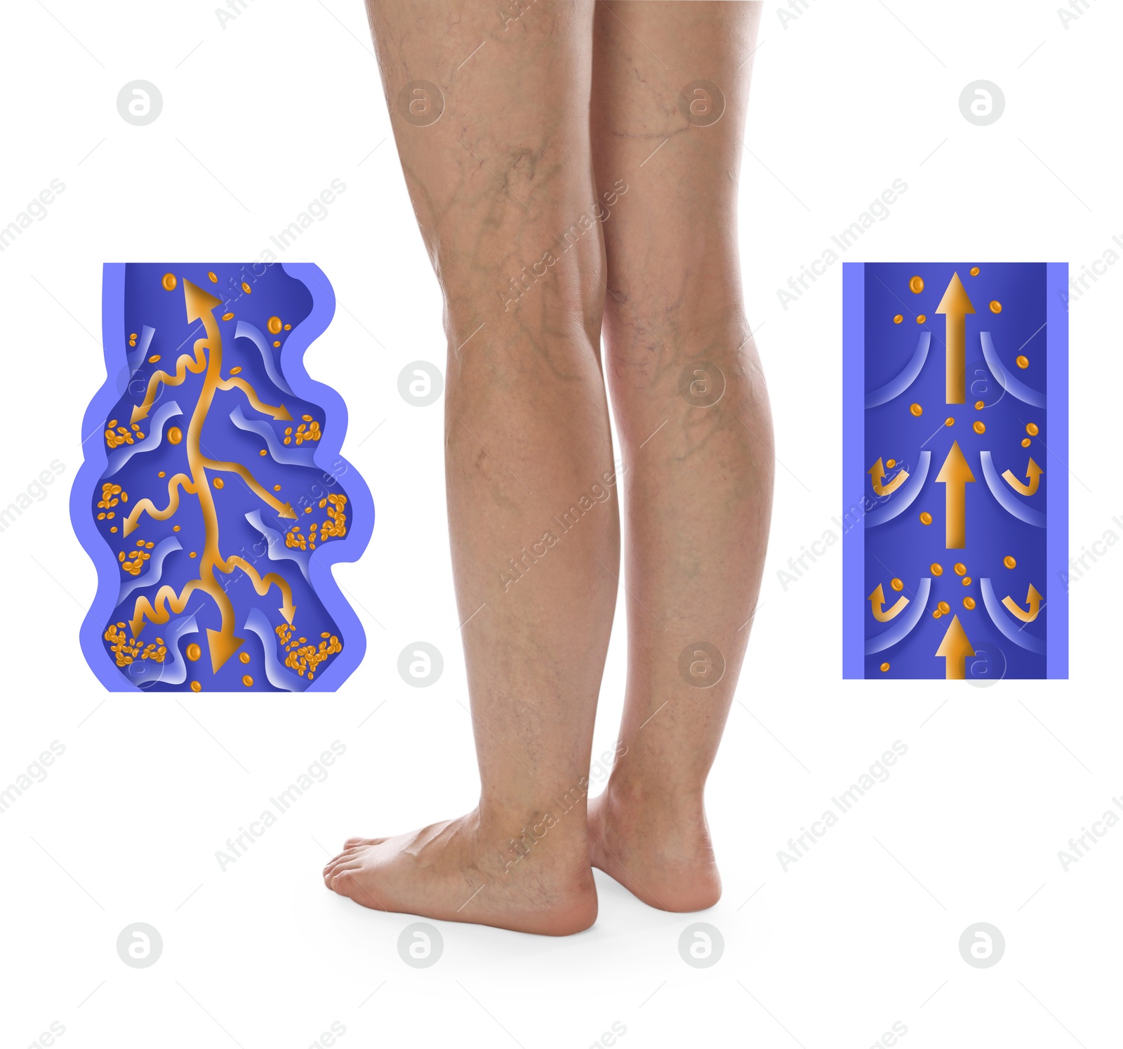 Image of Varicose veins. Woman showing legs on white background, closeup. Illustrations of damaged and healthy vein, longitudinal section