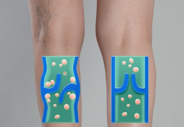 Image of Varicose veins. Woman showing legs on grey background, closeup. Illustrations of damaged and healthy vein, longitudinal section