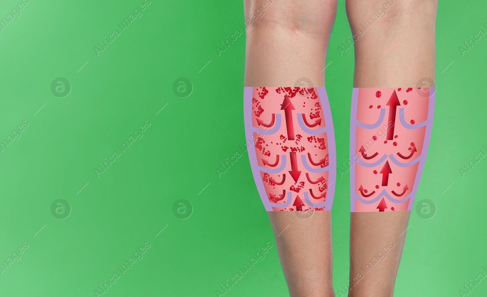 Image of Varicose veins. Woman showing legs on green background, closeup. Illustrations of damaged and healthy vein, longitudinal section