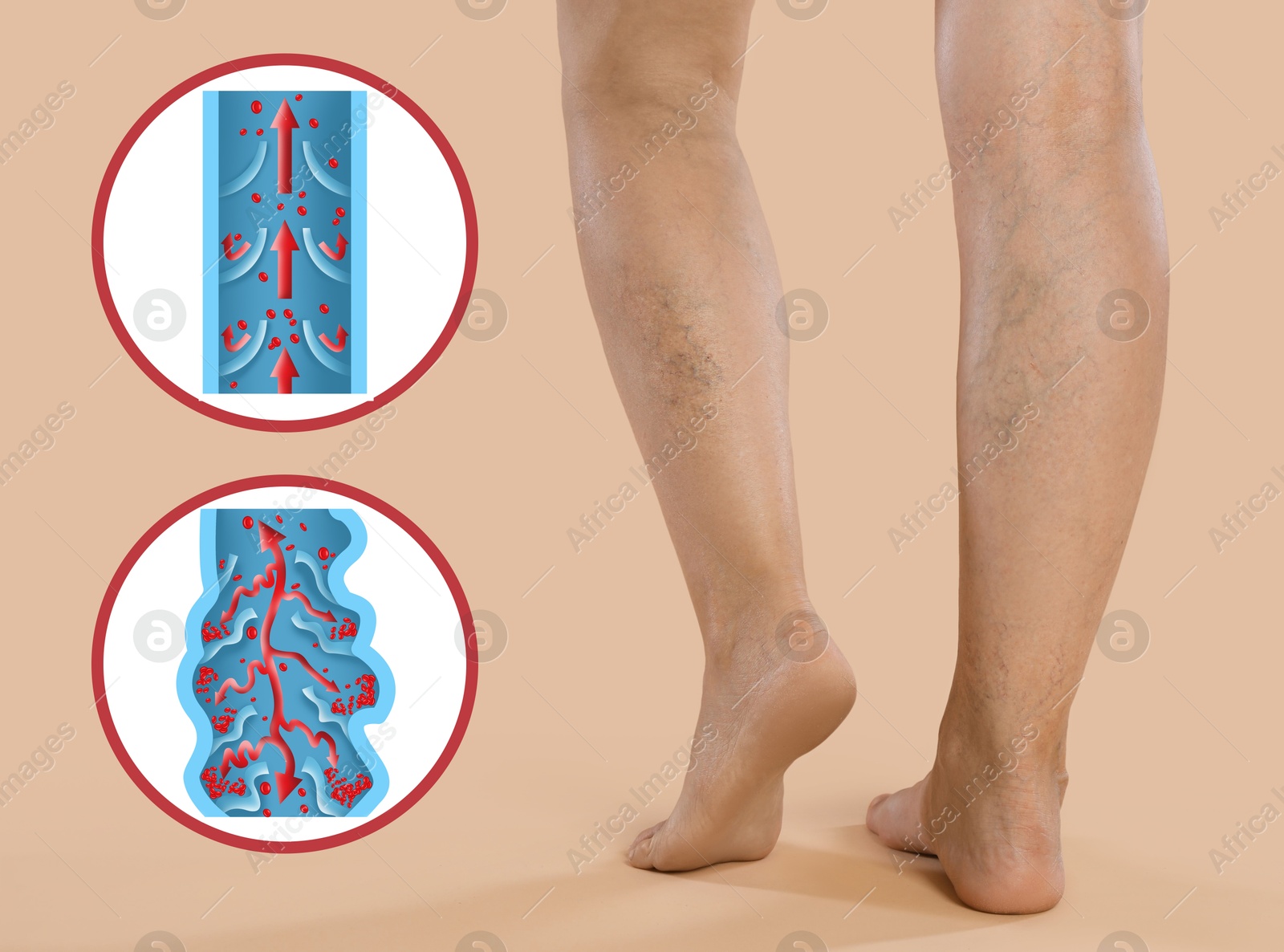 Image of Varicose veins. Woman showing legs on beige background, closeup. Illustrations of damaged and healthy vein, longitudinal section