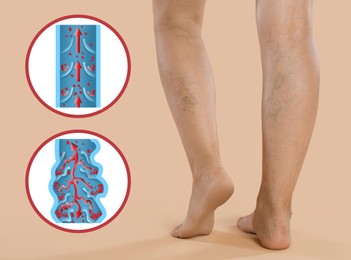 Image of Varicose veins. Woman showing legs on beige background, closeup. Illustrations of damaged and healthy vein, longitudinal section