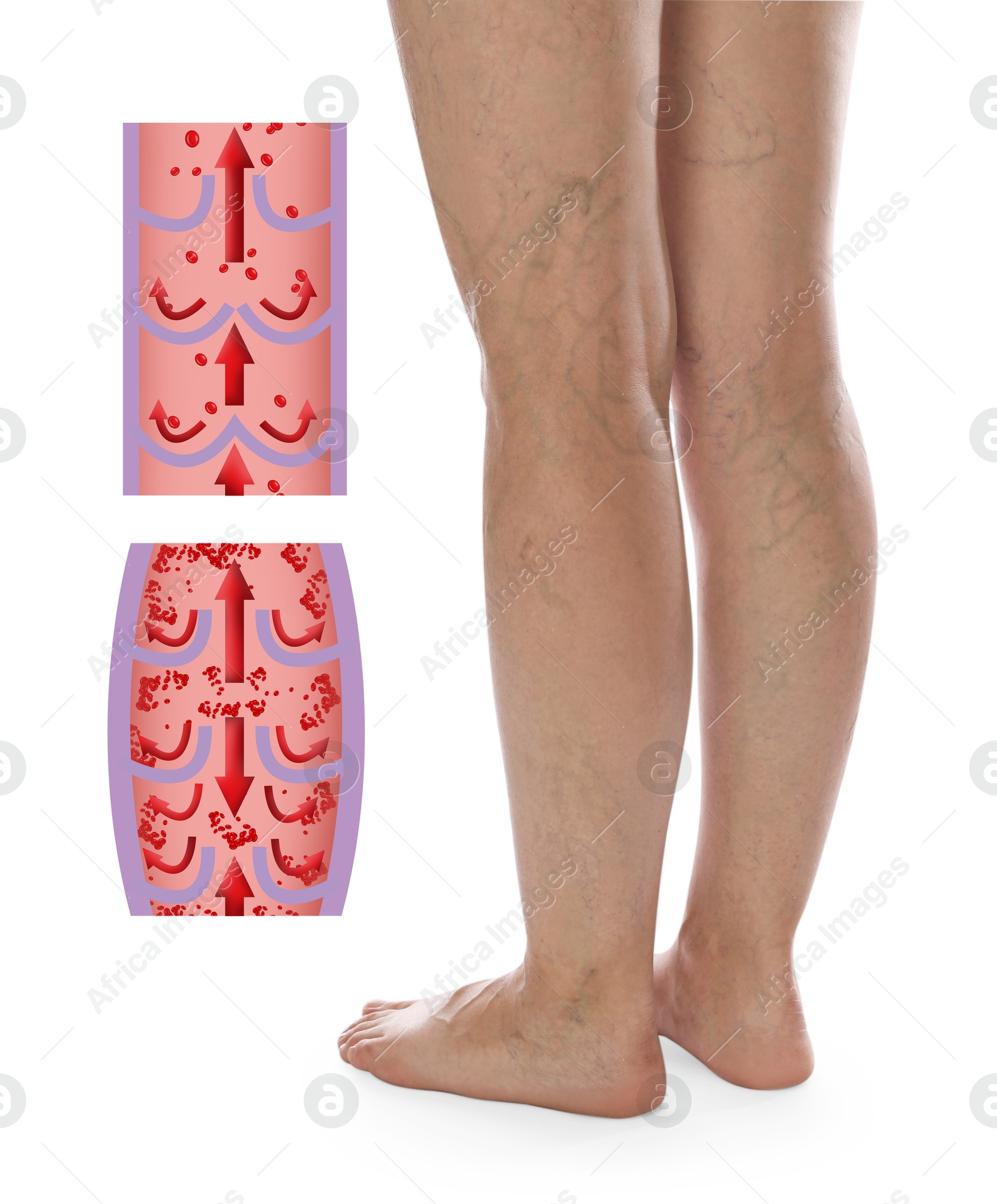 Image of Varicose veins. Woman showing legs on white background, closeup. Illustrations of damaged and healthy vein, longitudinal section