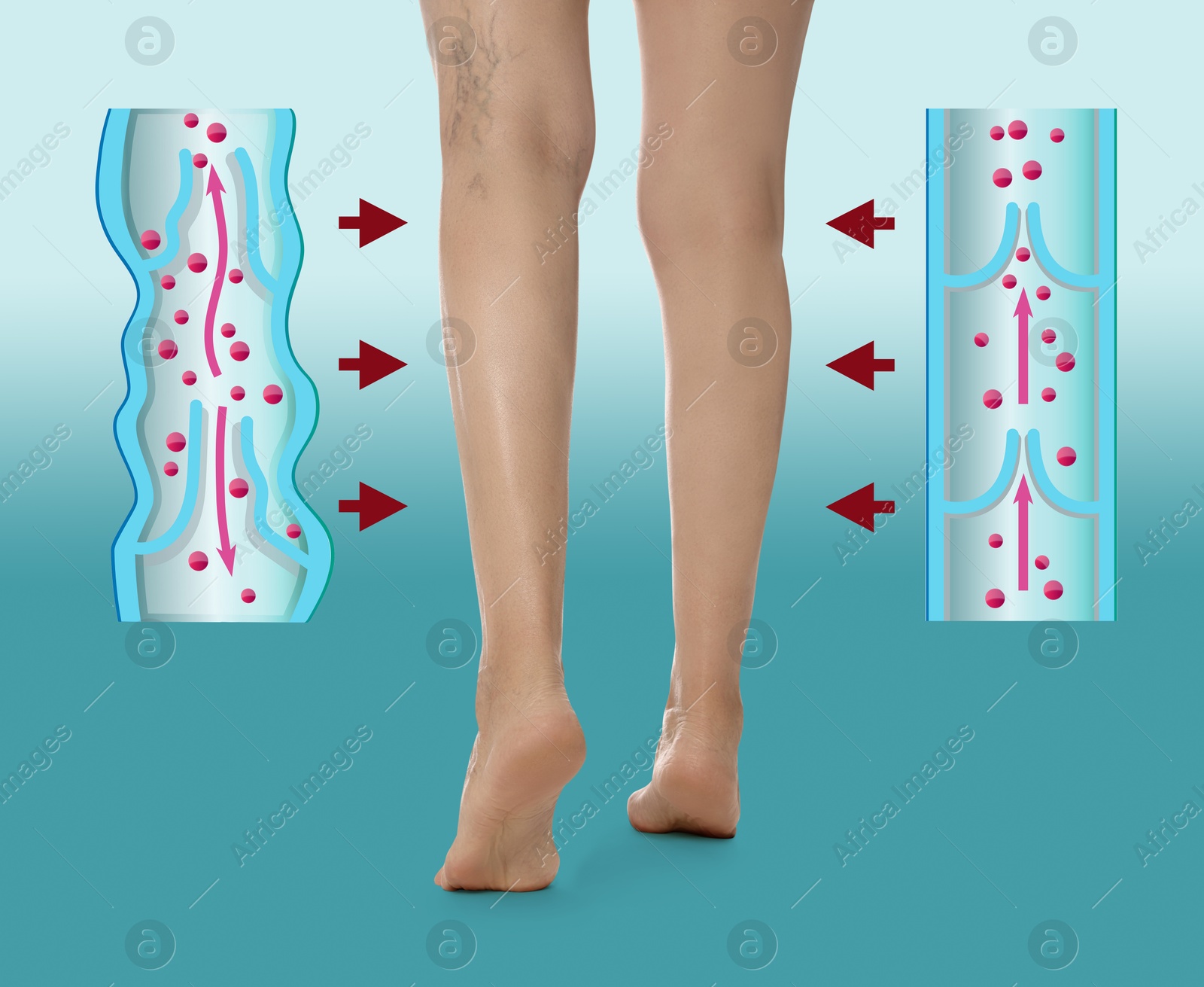 Image of Varicose veins. Woman showing legs on turquoise gradient background, closeup. Illustrations of damaged and healthy vein, longitudinal section