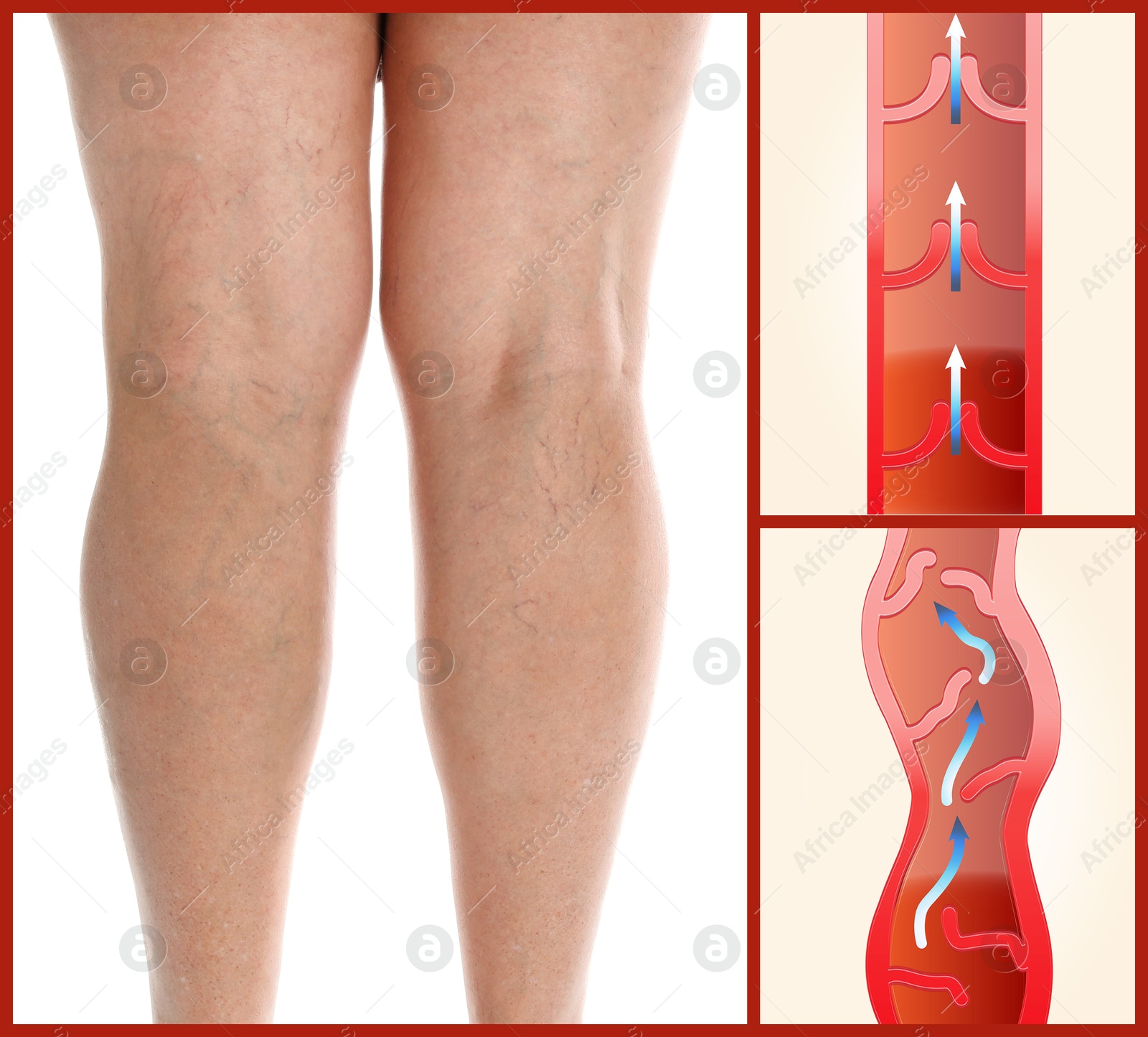 Image of Varicose veins. Woman showing legs on white background, closeup. Illustrations of damaged and healthy vein, longitudinal section