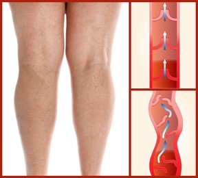 Image of Varicose veins. Woman showing legs on white background, closeup. Illustrations of damaged and healthy vein, longitudinal section