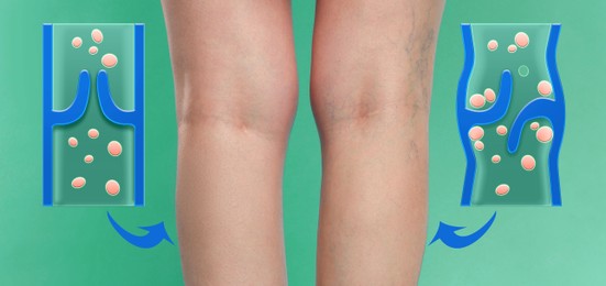 Image of Varicose veins. Woman showing legs on turquoise background, closeup. Illustrations of damaged and healthy vein, longitudinal section