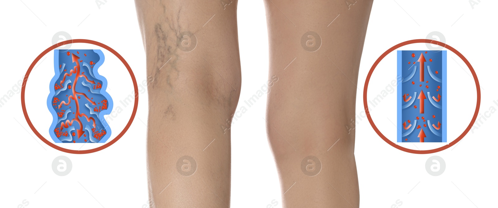 Image of Varicose veins. Woman showing legs on white background, closeup. Illustrations of damaged and healthy vein, longitudinal section