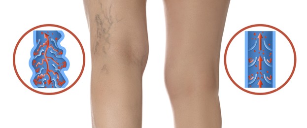 Image of Varicose veins. Woman showing legs on white background, closeup. Illustrations of damaged and healthy vein, longitudinal section