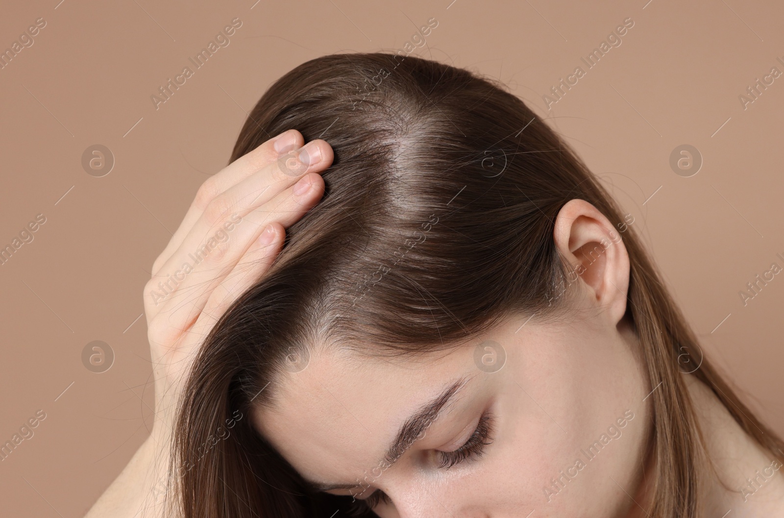 Photo of Girl with hair loss problem on dark beige background