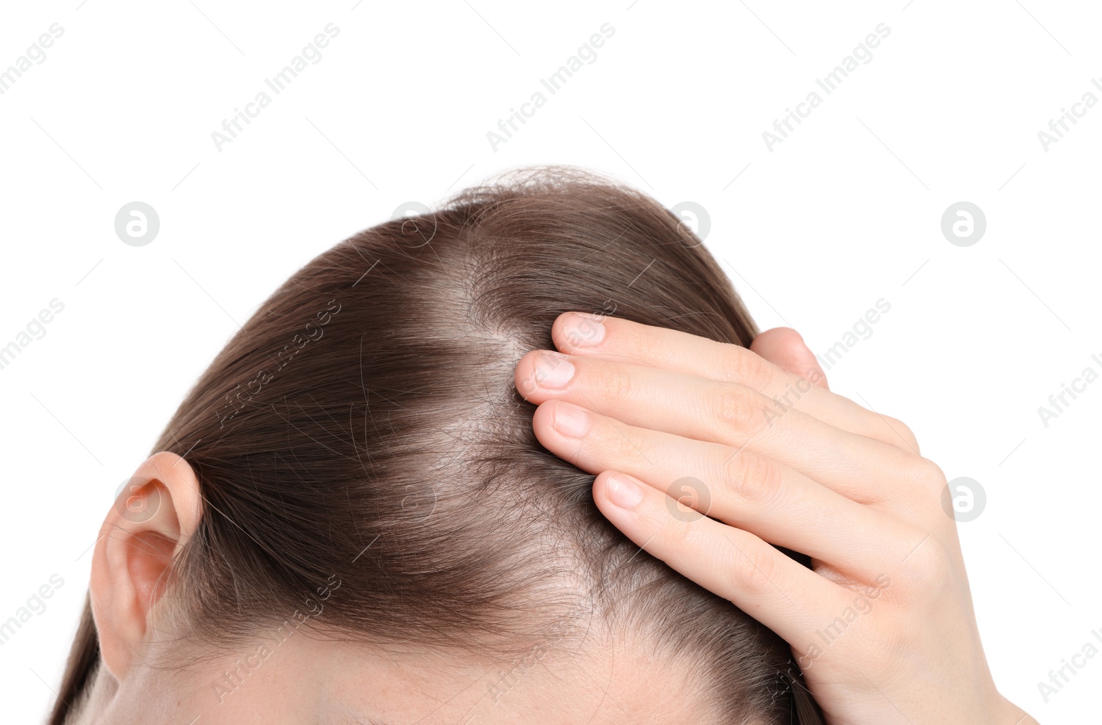 Photo of Girl with hair loss problem on white background, closeup