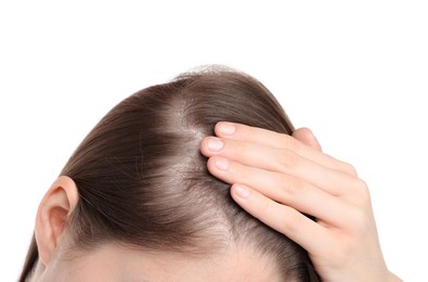 Photo of Girl with hair loss problem on white background, closeup