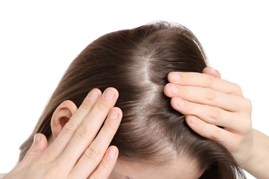 Photo of Girl with hair loss problem on white background, closeup