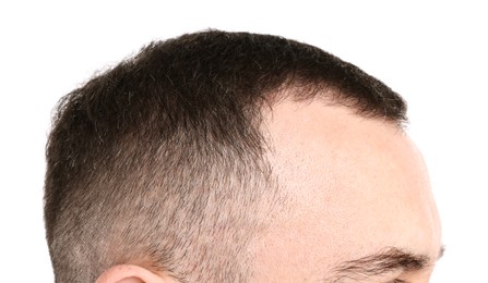 Photo of Baldness problem. Man with receding hairline on white background, closeup