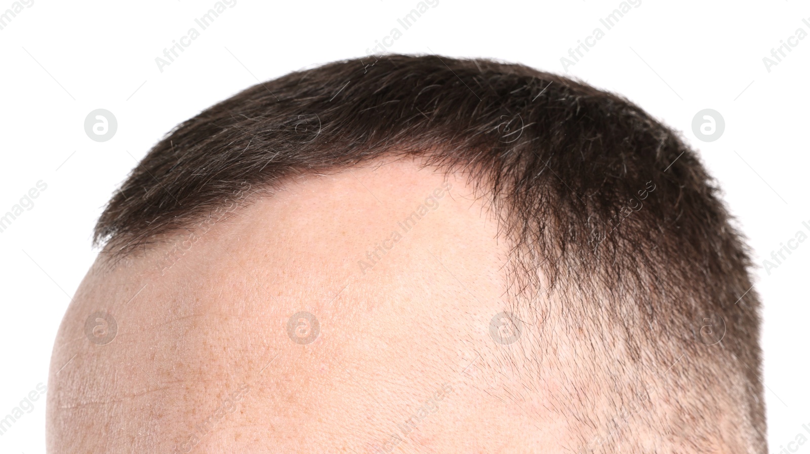 Photo of Baldness problem. Man with receding hairline on white background, closeup