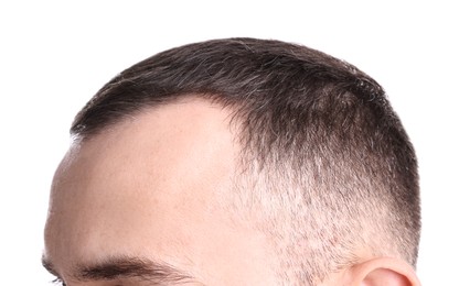 Photo of Baldness problem. Man with receding hairline on white background, closeup