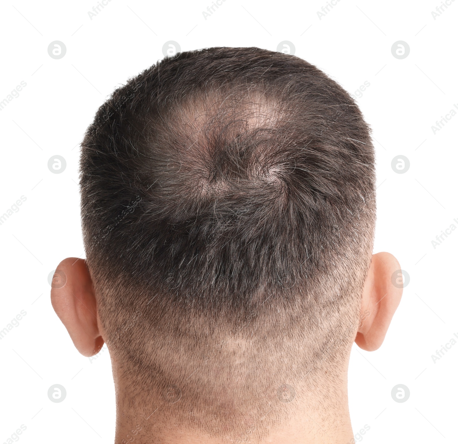 Photo of Man suffering from baldness on white background, back view