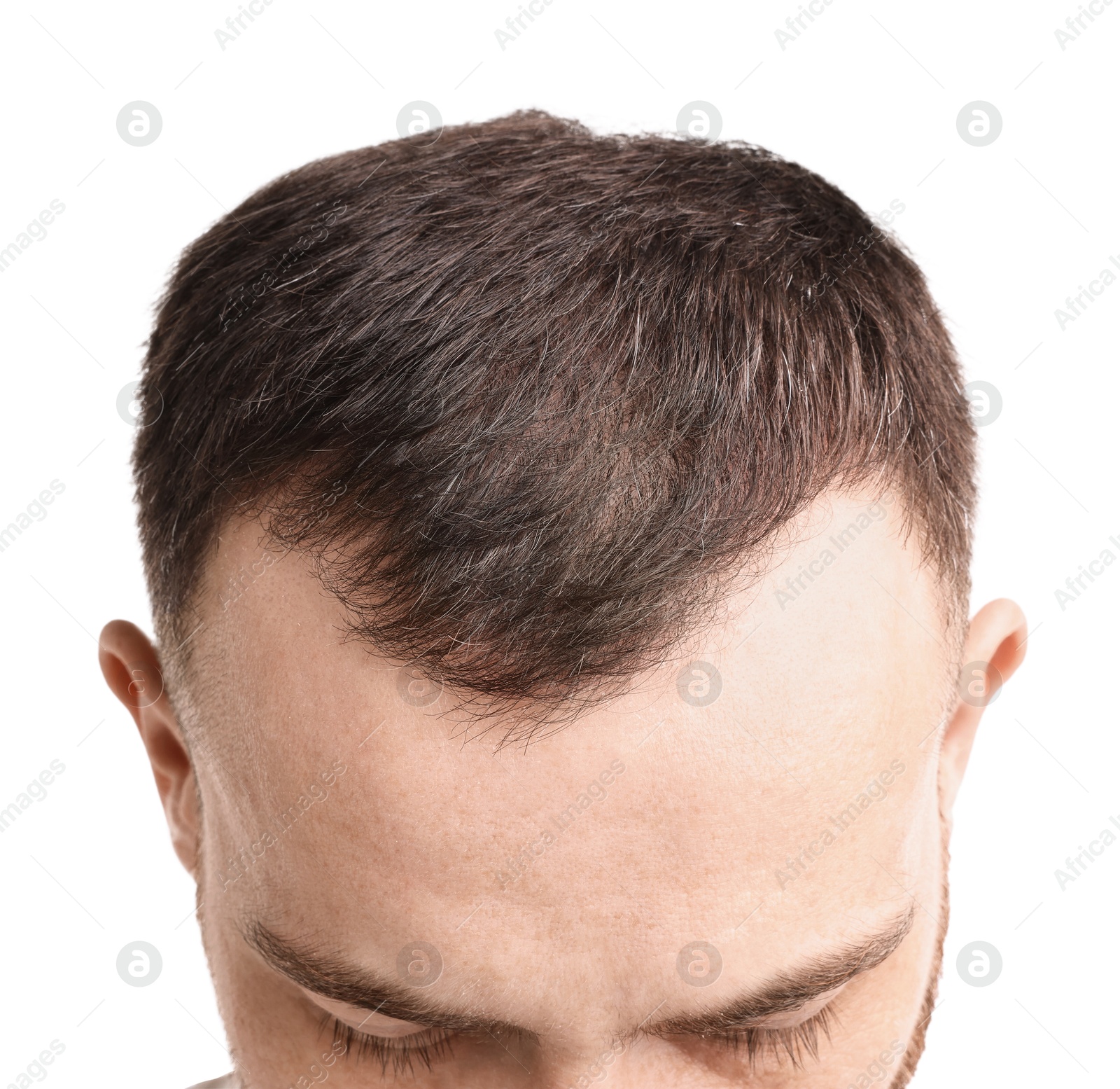 Photo of Baldness problem. Man with receding hairline on white background, closeup