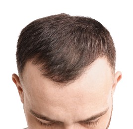 Photo of Baldness problem. Man with receding hairline on white background, closeup