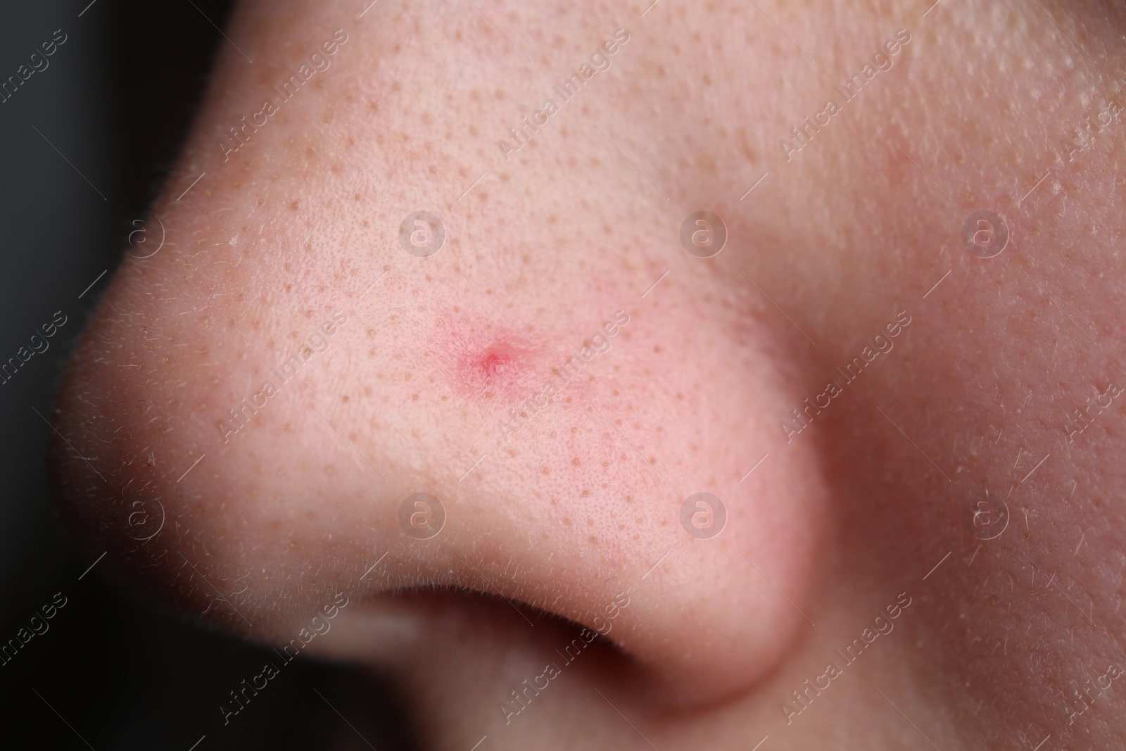 Photo of Woman with pimple on her nose, closeup