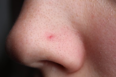 Photo of Woman with pimple on her nose, closeup