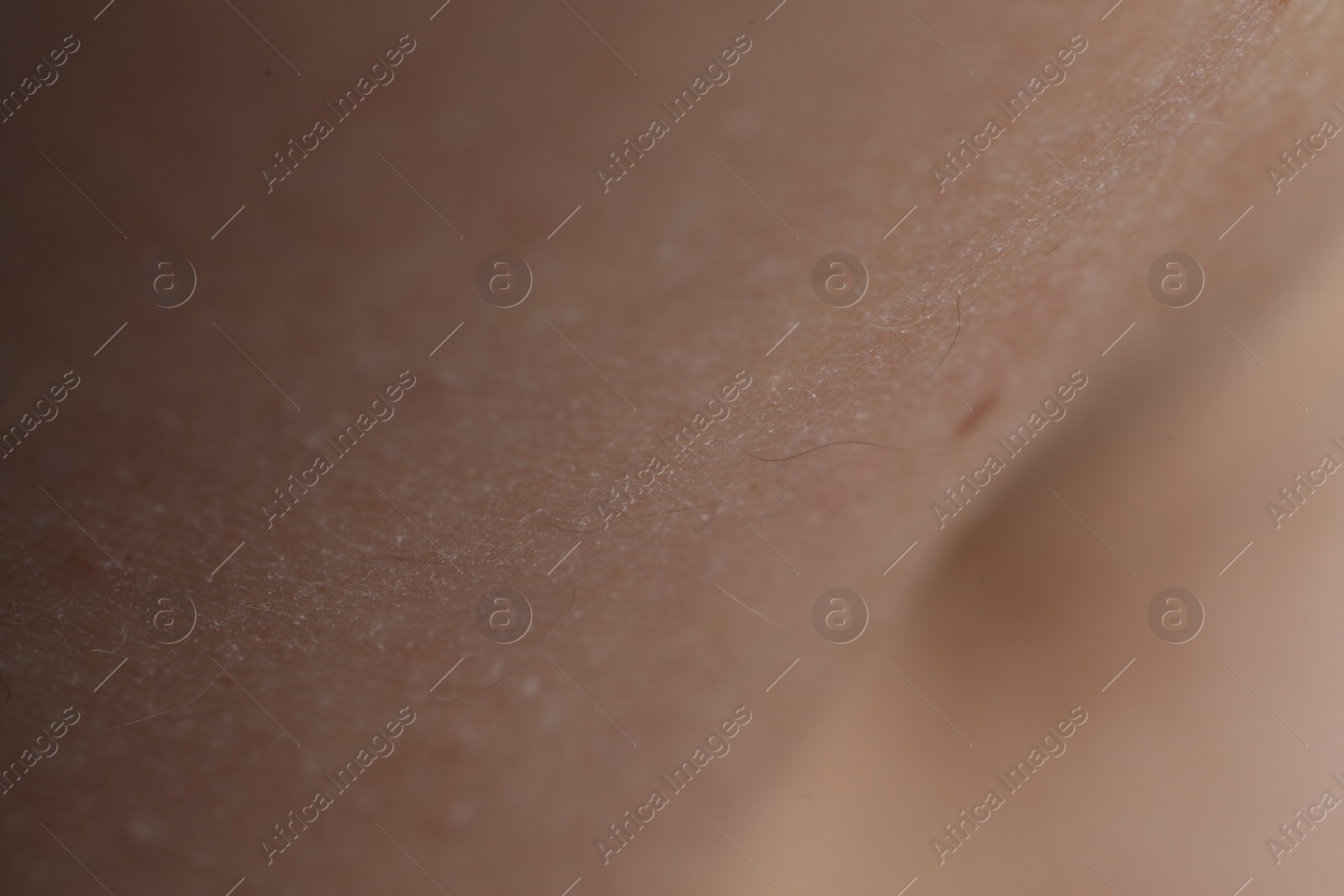 Photo of Texture of dry skin as background, closeup